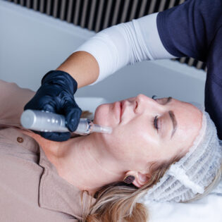 Microneedling + Exosomes Package of 4 Treatments - 60% Off