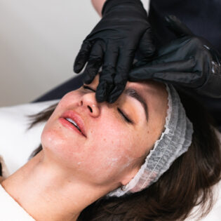 KB Pure Advanced Peels Package of 3 Treatments – 40% Off